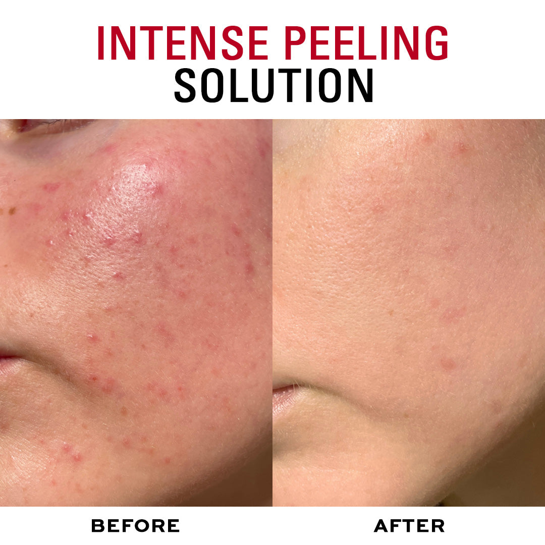 Revolution Skincare Multi Acid AHA and BHA Peel Serum