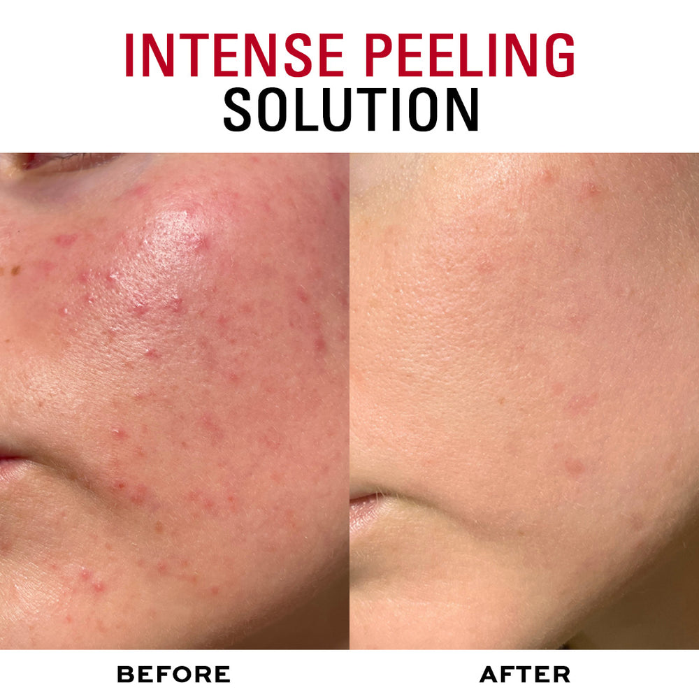 Revolution Skincare Multi Acid AHA and BHA Peel Serum