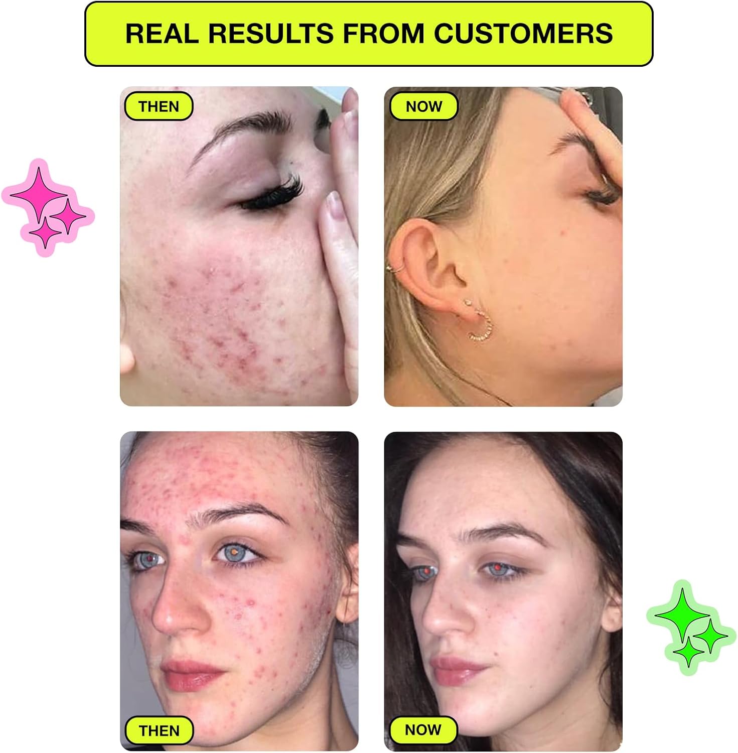 Carbon Theory Supacylic Pin Point Zap Patch x40